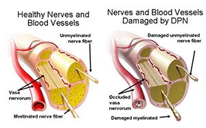 neuropathy diabet