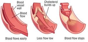 cara menurunkan kolestrol dengan cepat