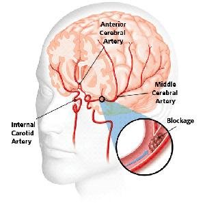 Stroke Penyumbatan Pembuluh Darah Atau Stroke Iskemik