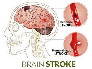 stroke penyumbatan pembuluh darah pada otak